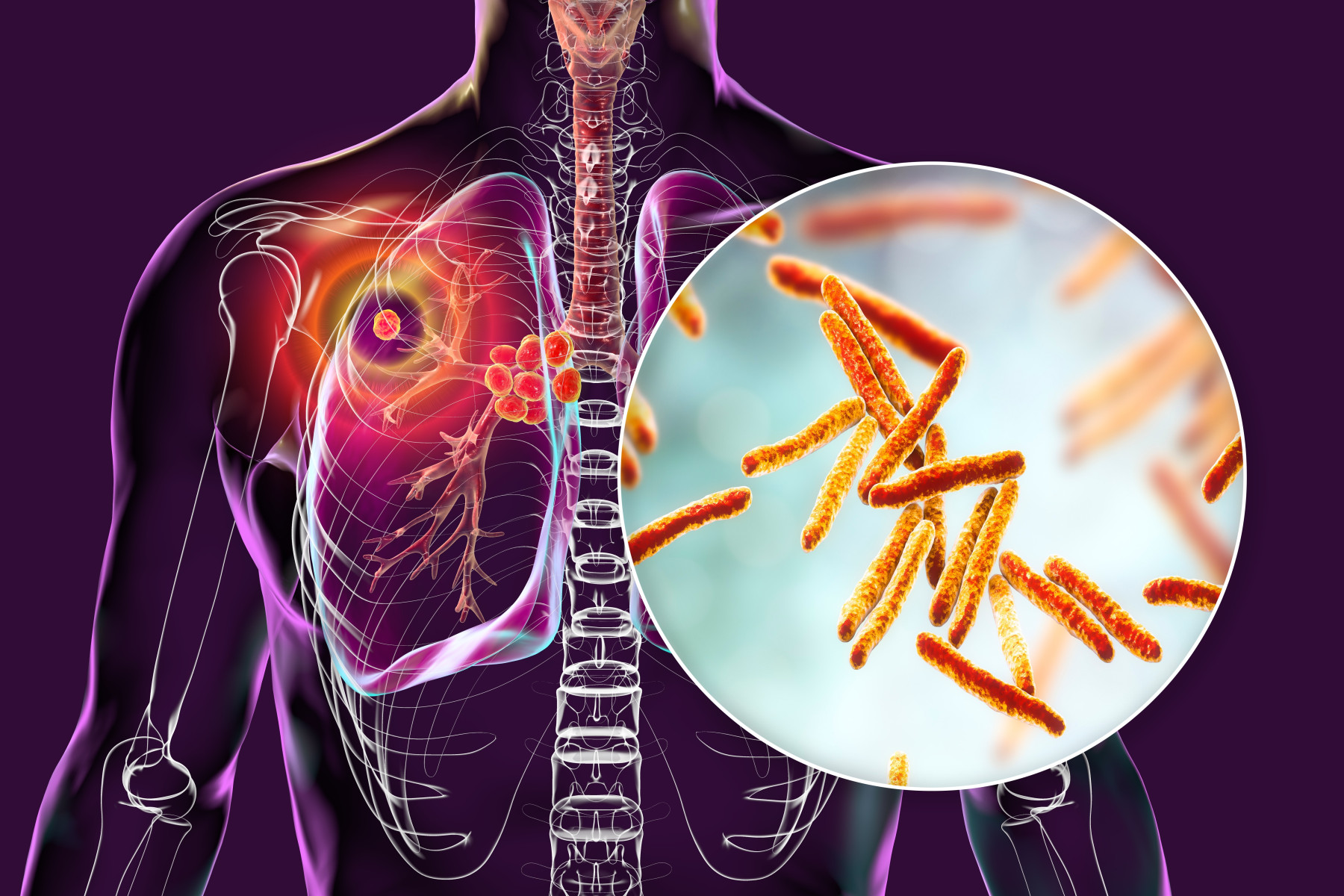 Understanding Tuberculosis