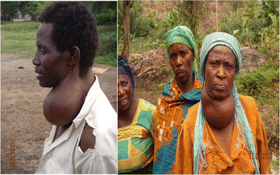A Guide to Understanding Goiter